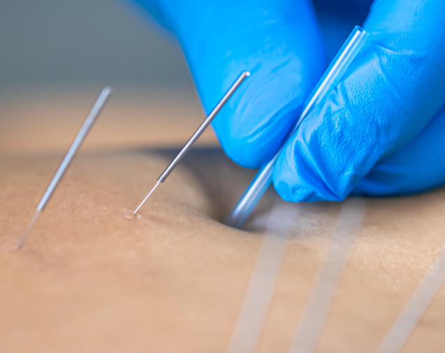 acupuncture-about